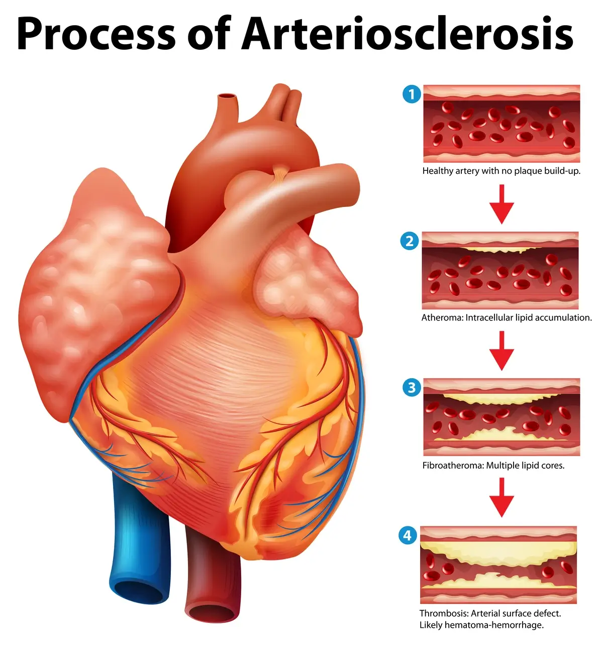Arteriolosclerosis - The Small Artery Challenger | https://www.harleystreet.sg/