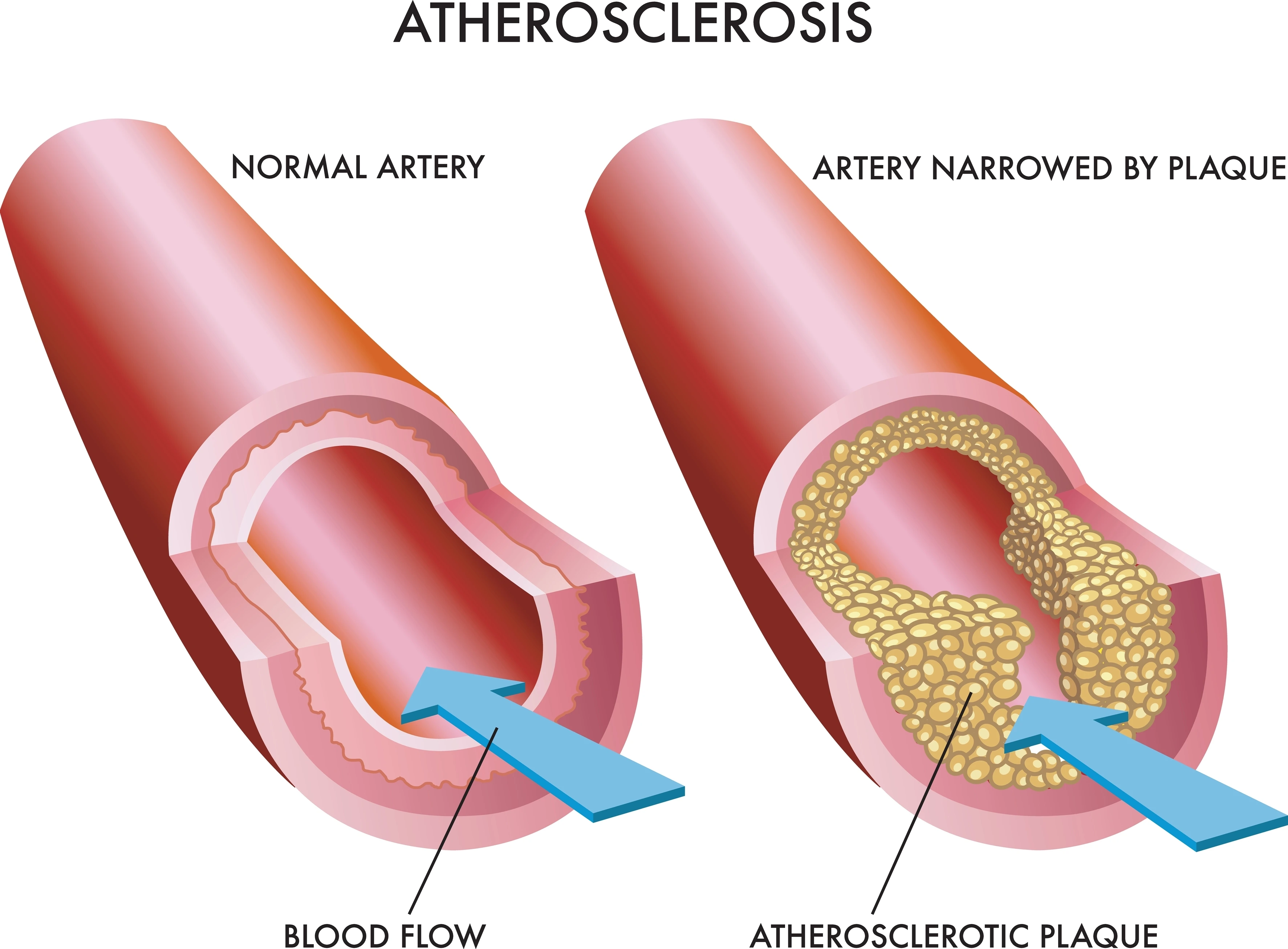 Atherosclerosis | https://www.harleystreet.sg/