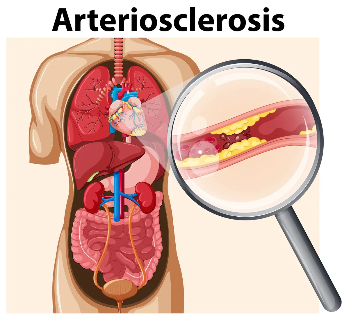 Diagnosing Arteriosclerosis | https://www.harleystreet.sg/