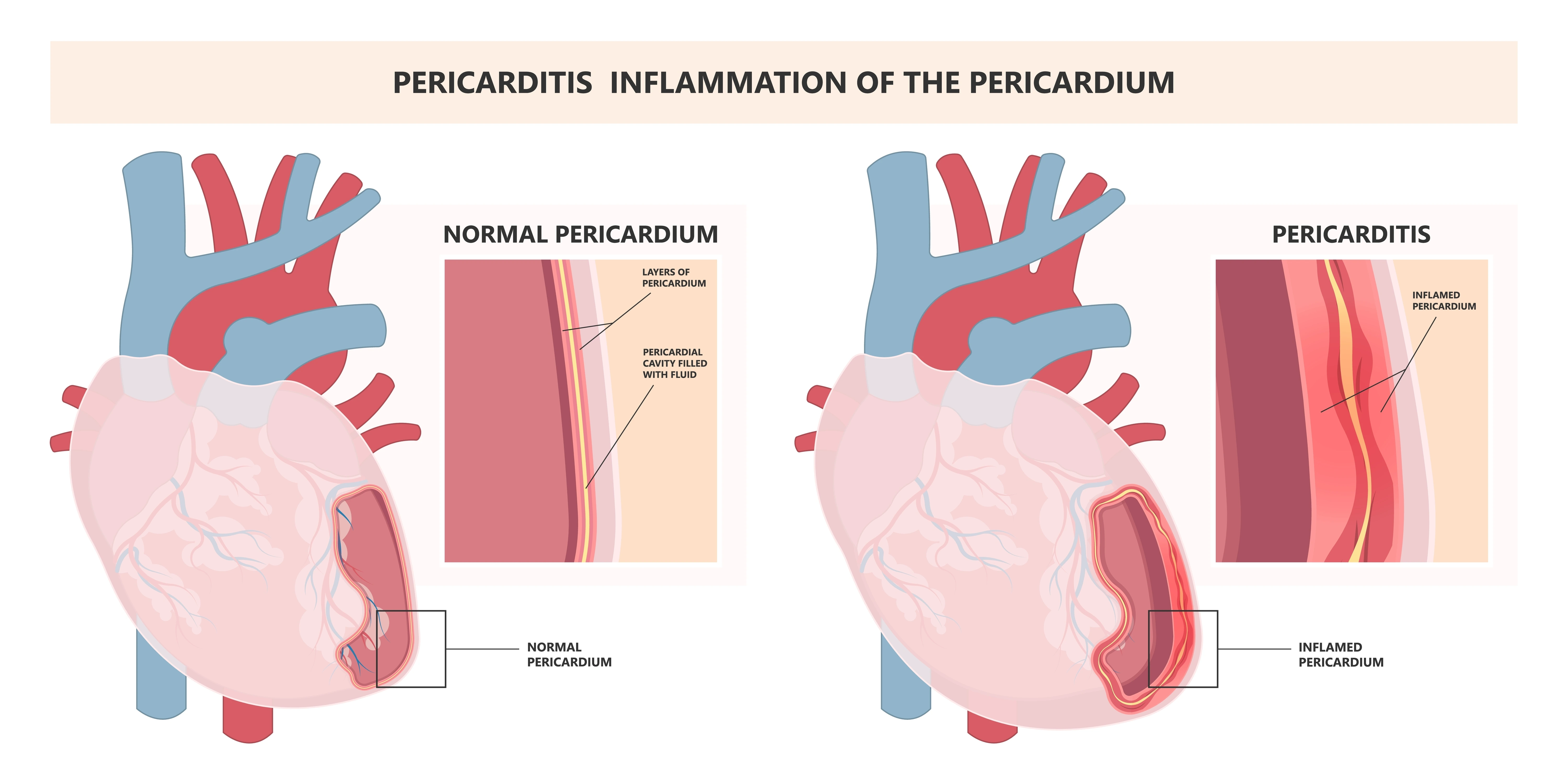 Inflammation of The Pericardium | https://www.harleystreet.sg/