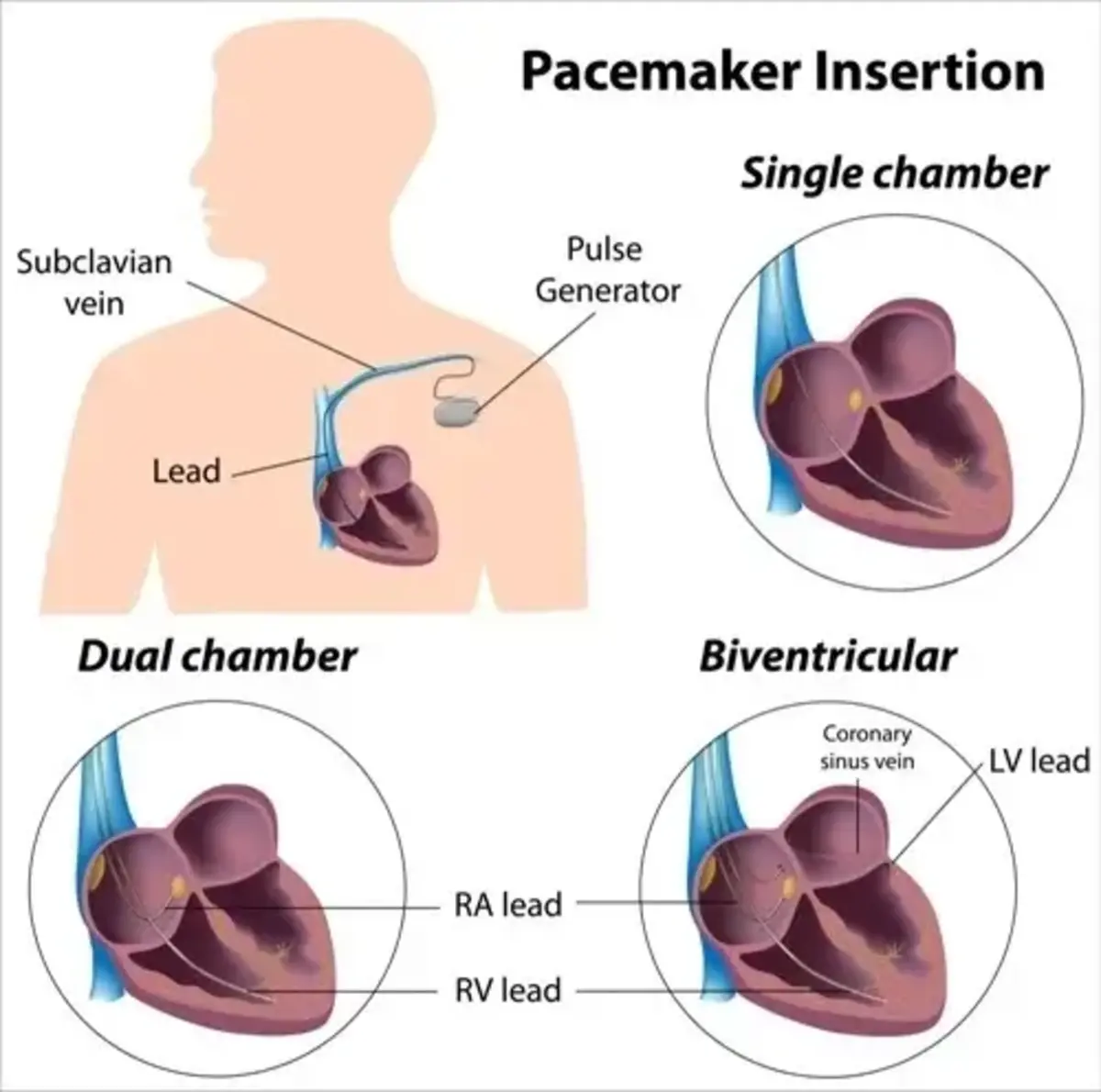 Pacemaker Insertion | https://www.harleystreet.sg/