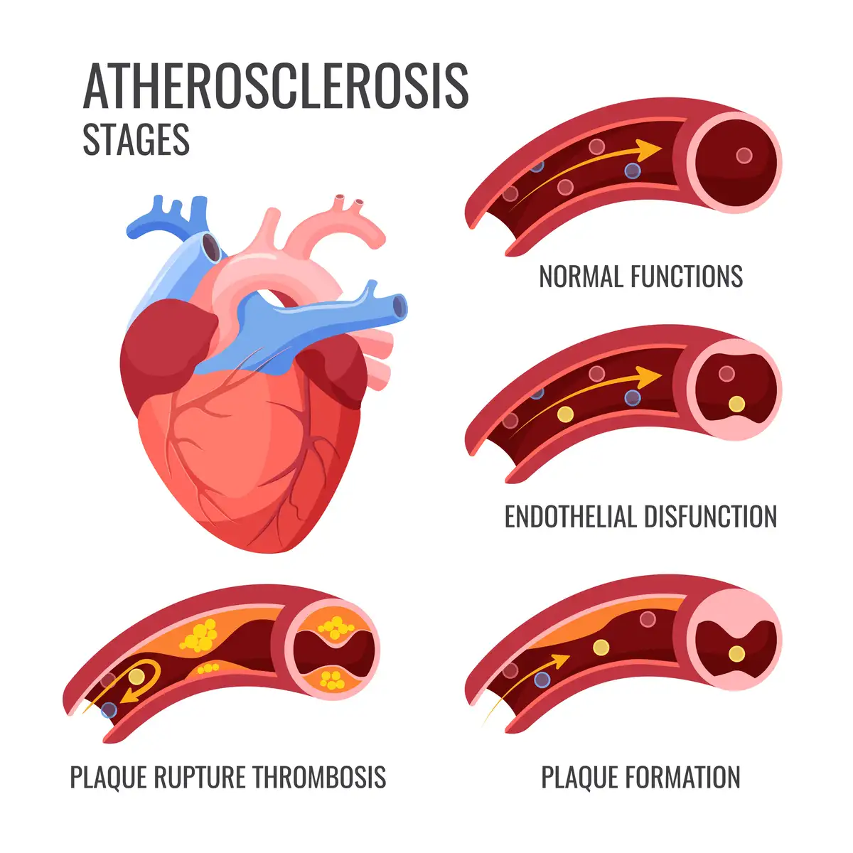 Stages of Atherosclerosis | https://www.harleystreet.sg/