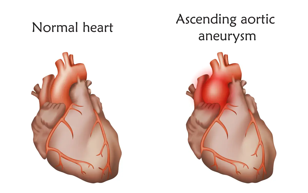 Types of Aortic Disease - Aortic Aneurysm | https://www.harleystreet.sg/