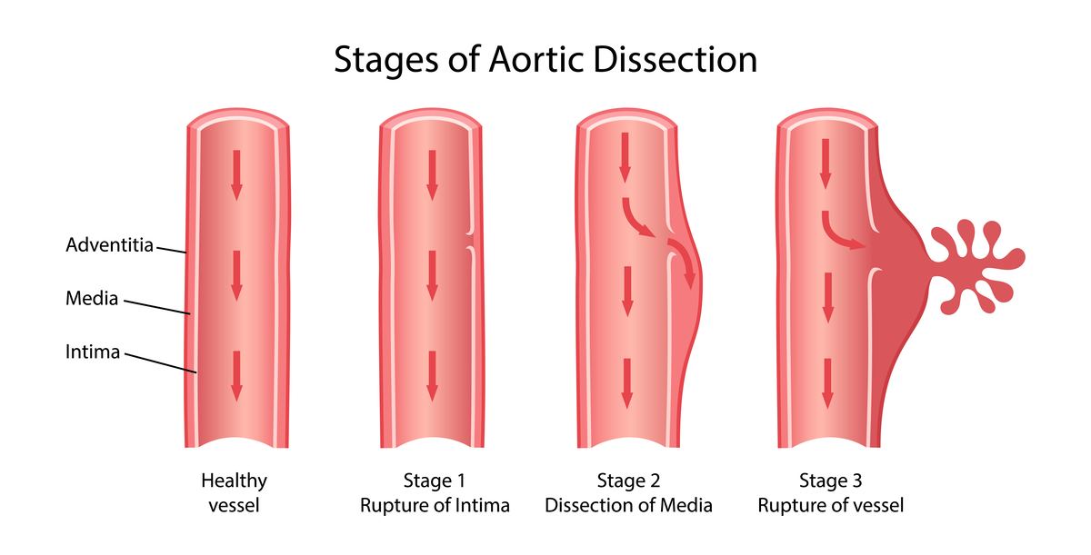 Types of Aortic Disease - Aortic Dissection | https://www.harleystreet.sg/
