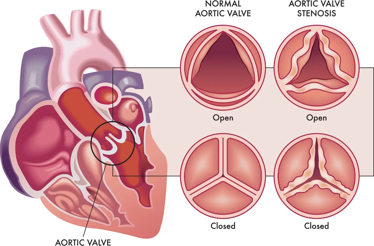 Types of Aortic Disease - Aortic Stenosis | https://www.harleystreet.sg/