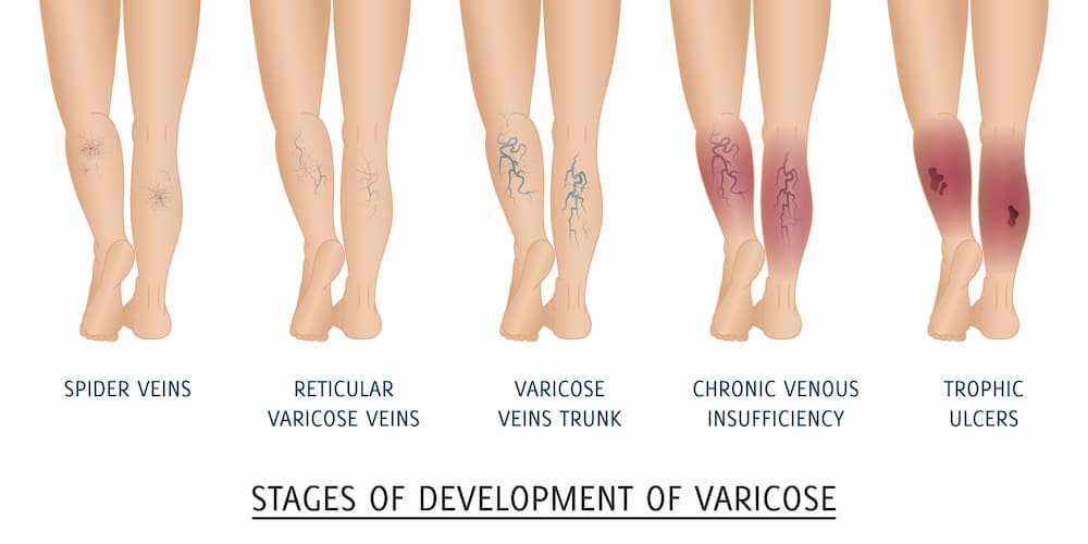 Stages Of Development Of Vein Disease