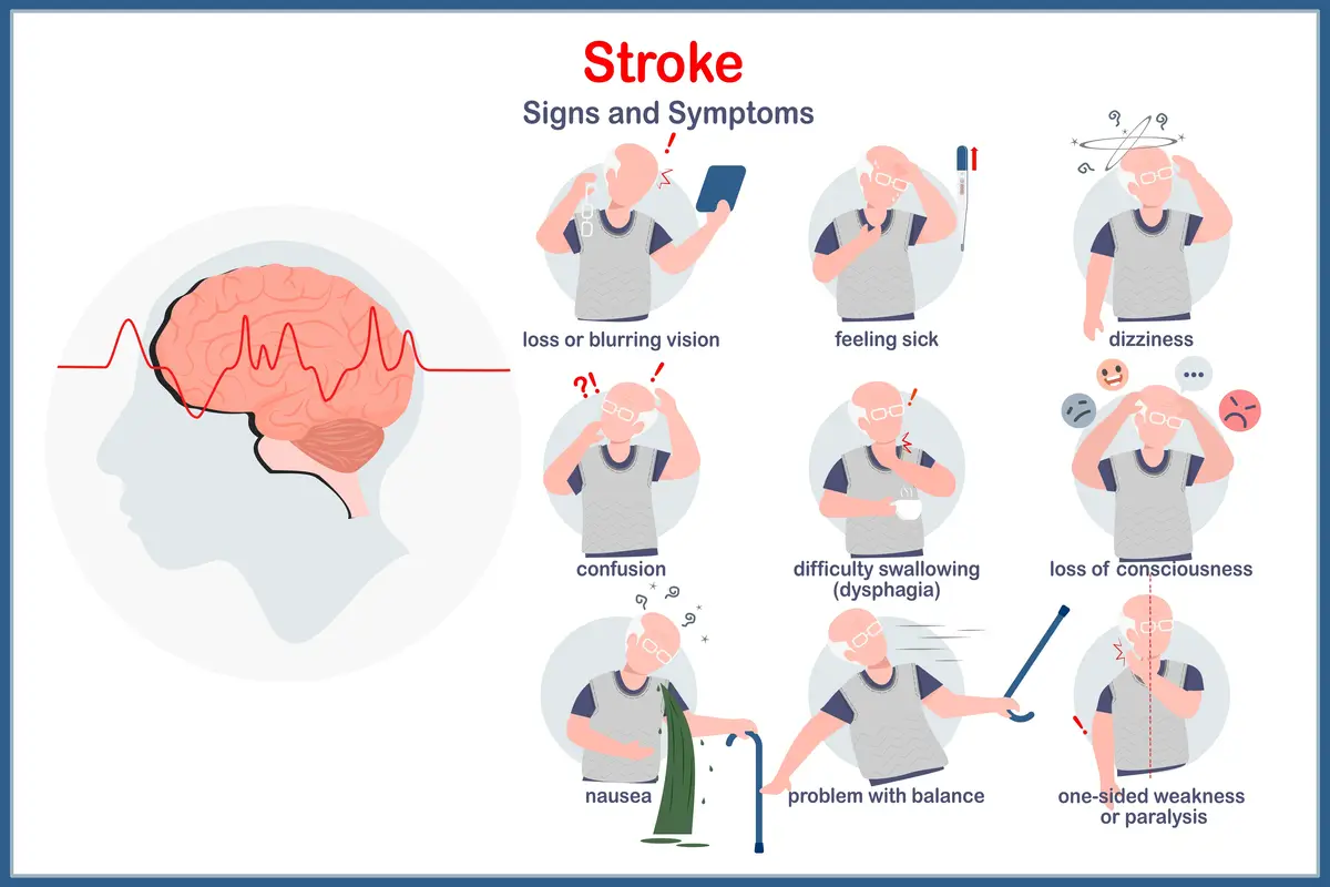 Symptoms of Stroke | https://www.harleystreet.sg/