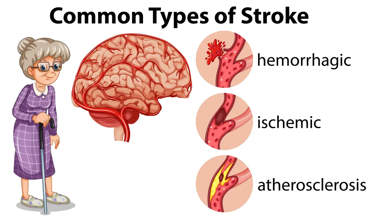 Types of Stroke | https://www.harleystreet.sg/