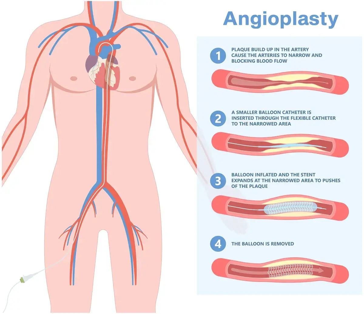 Understanding Angioplasty Procedure | https://www.harleystreet.sg/