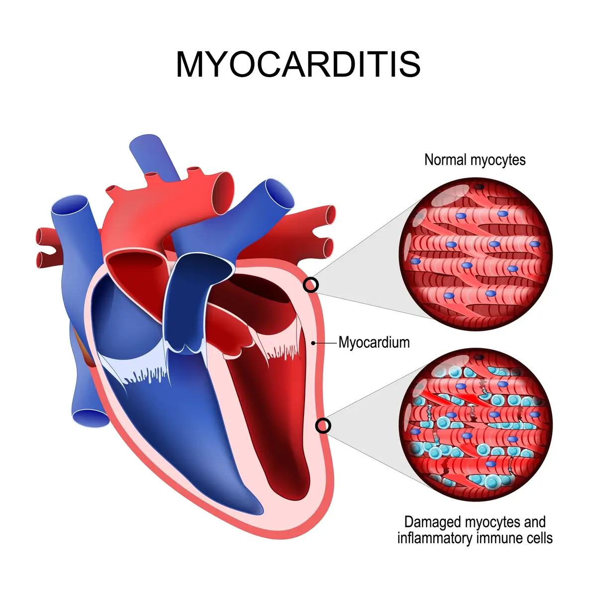 What is Myocarditis | https://www.harleystreet.sg/