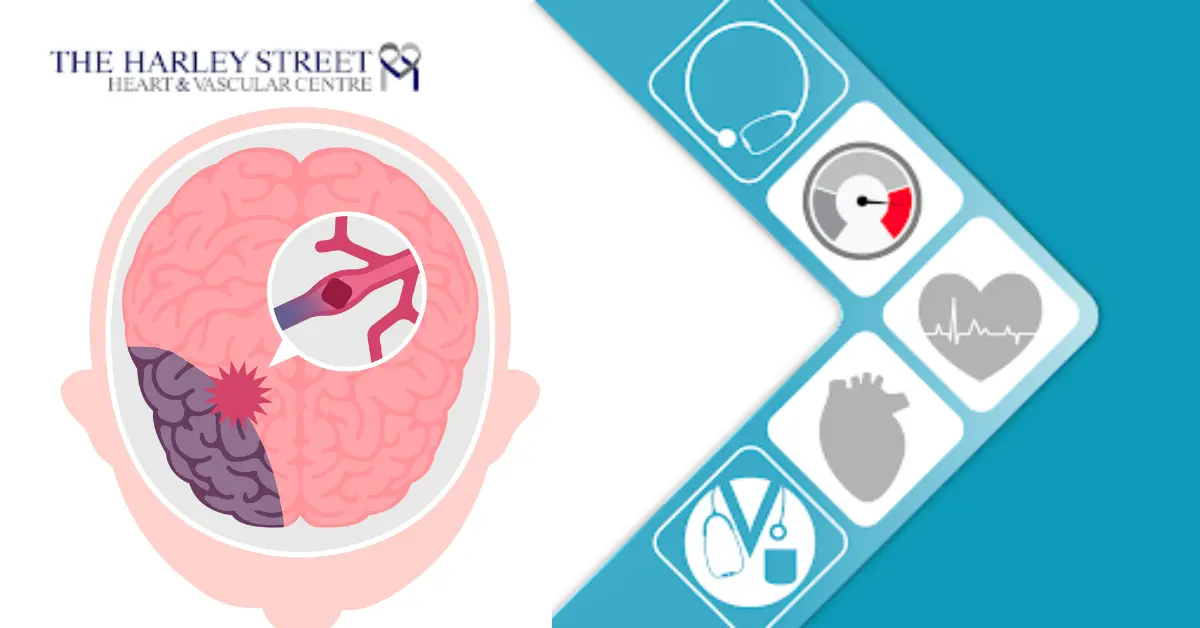 What is a Stroke | https://www.harleystreet.sg/