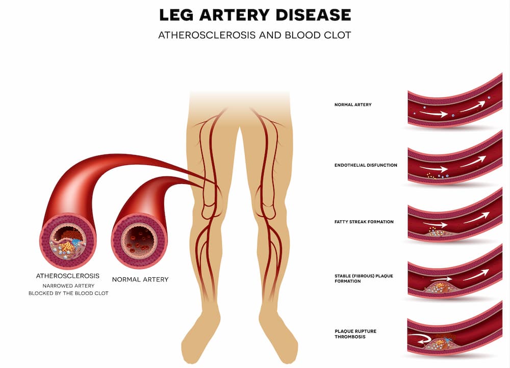 Peripheral Arterial Disease