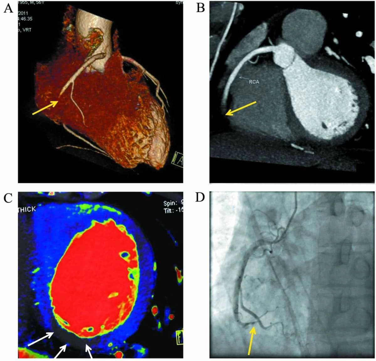 Coronary Angiogram