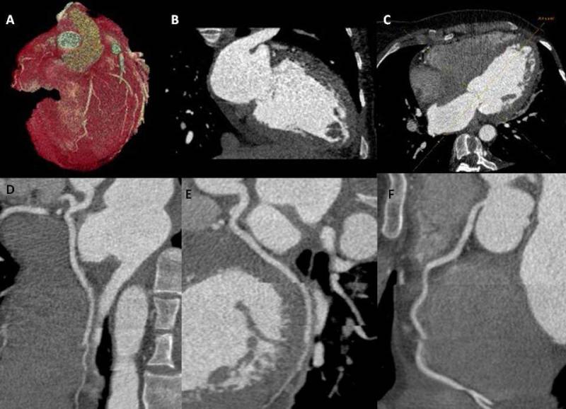 What is Computed Tomography Coronary Angiography (CTCA)