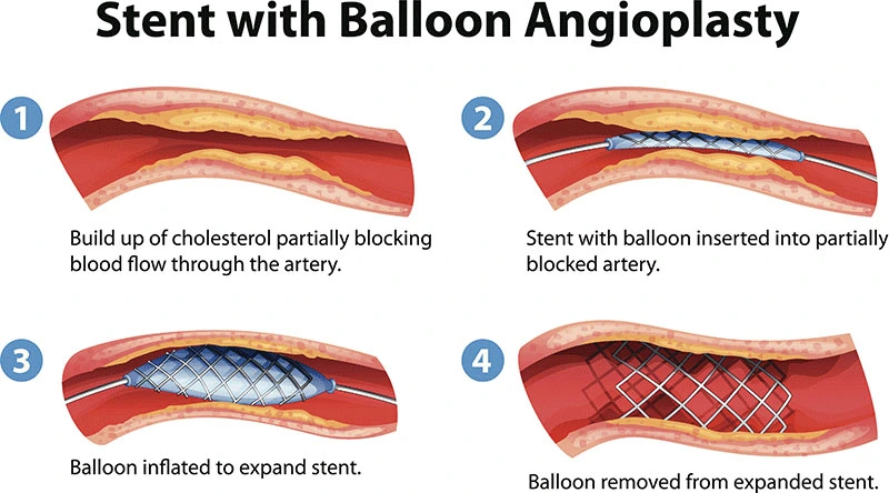 What is Coronary Angioplasty?