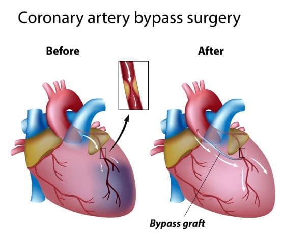 Heart Bypass Surgery