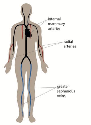 Heart Bypass Surgery