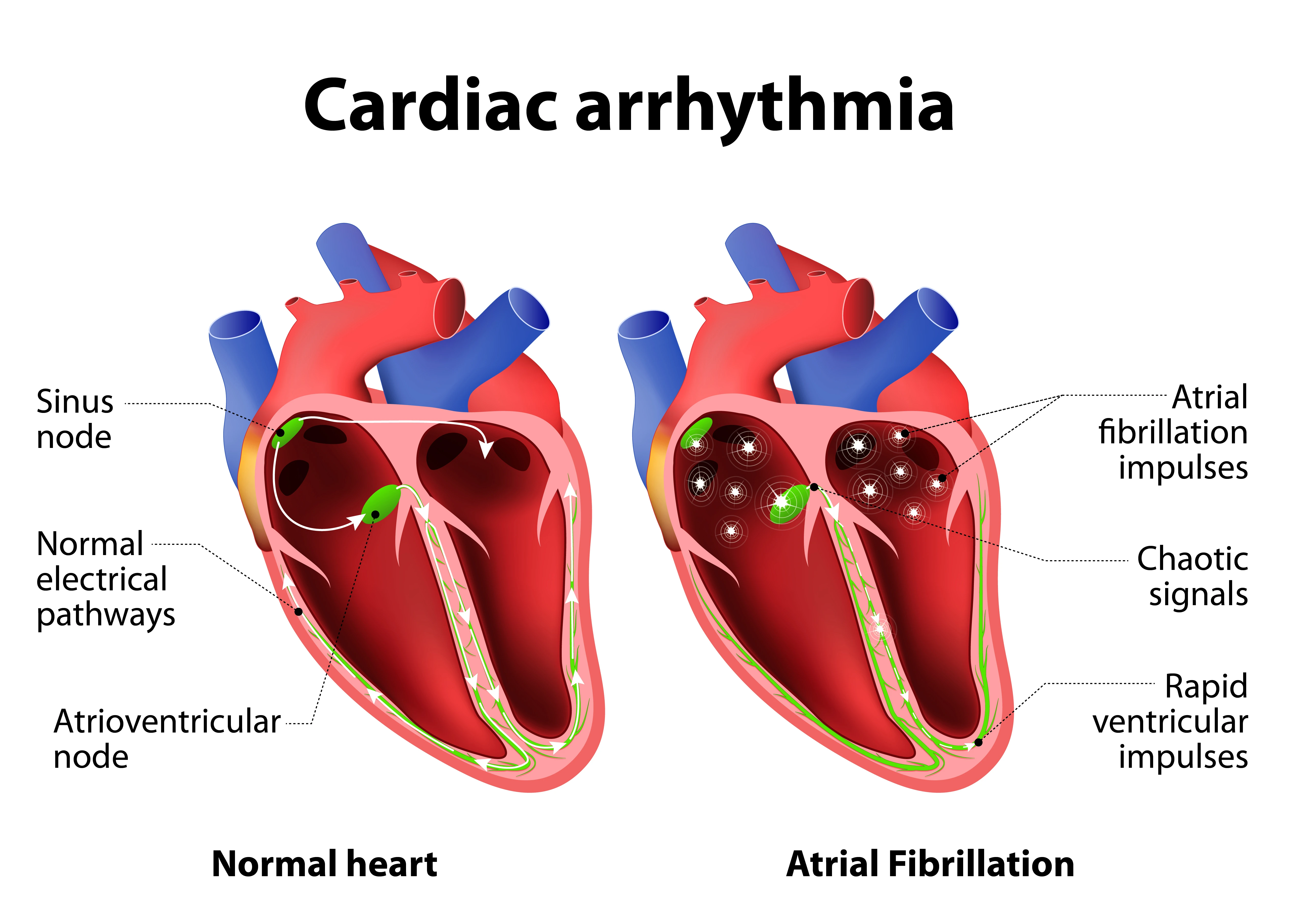 Atrial Fibrillation | https://www.harleystreet.sg/