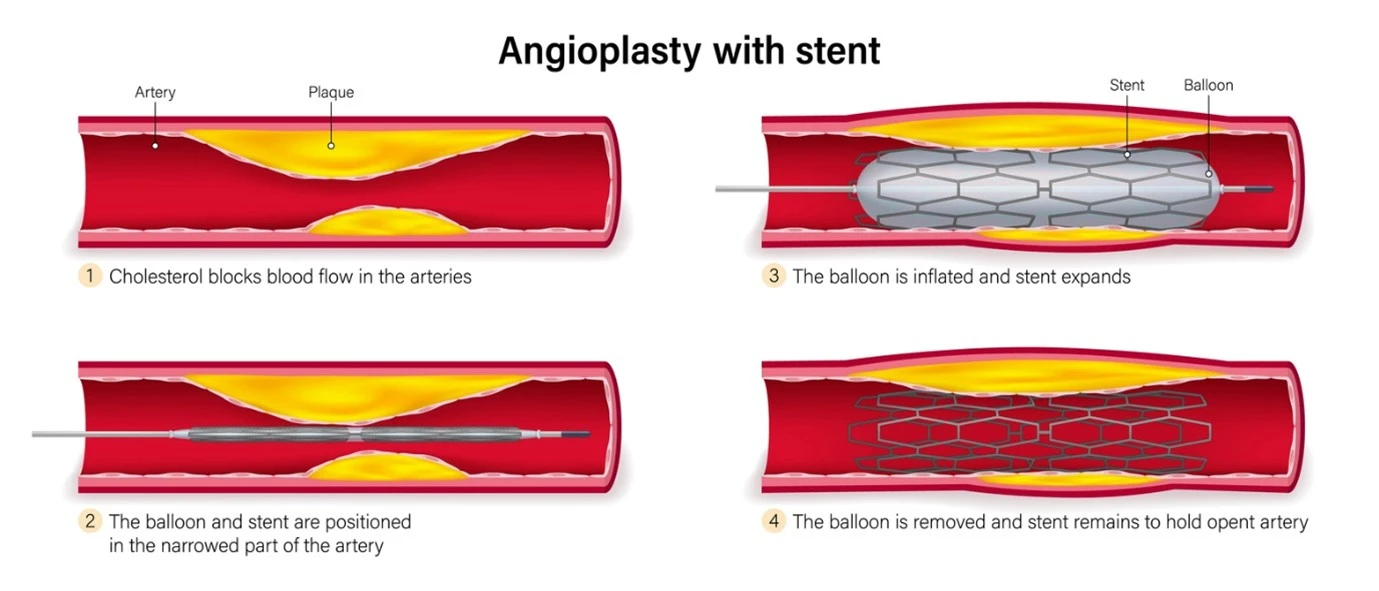 Non-surgical treatment to reverse blocked coronary arteries