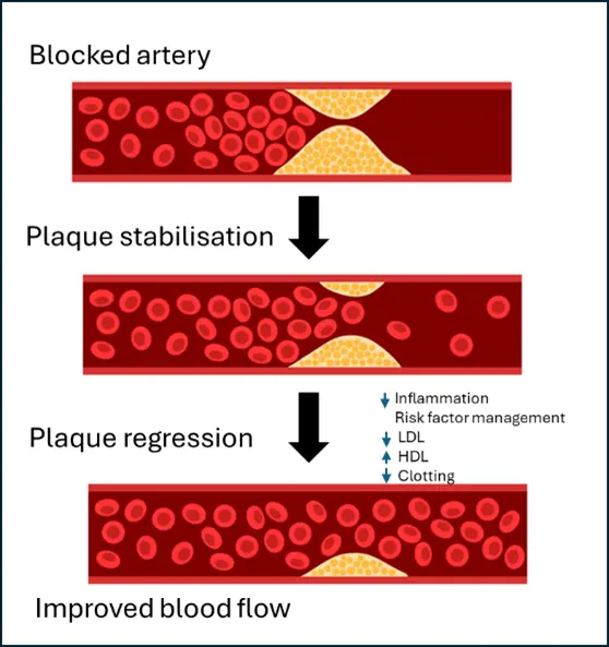 Non-surgical treatment to reverse blocked coronary arteries