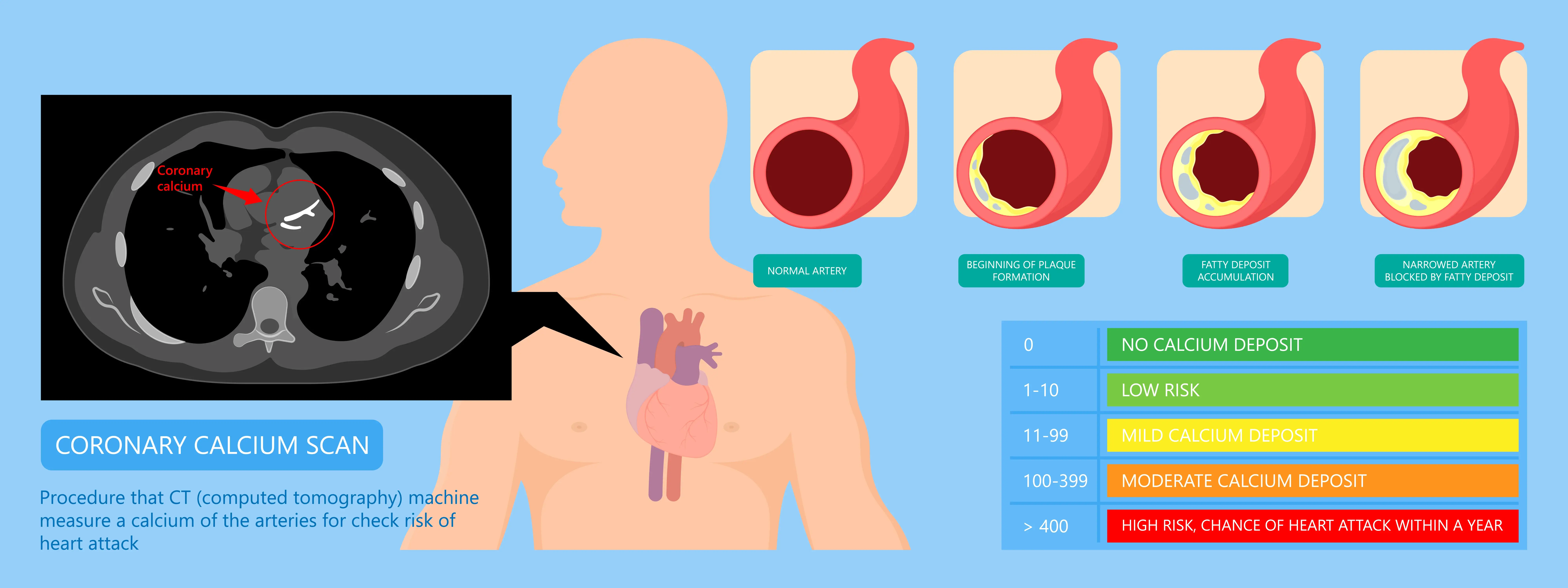 Coronary Calcium Score - Cardiac CT for Calcium Scoring | https://www.harleystreet.sg/