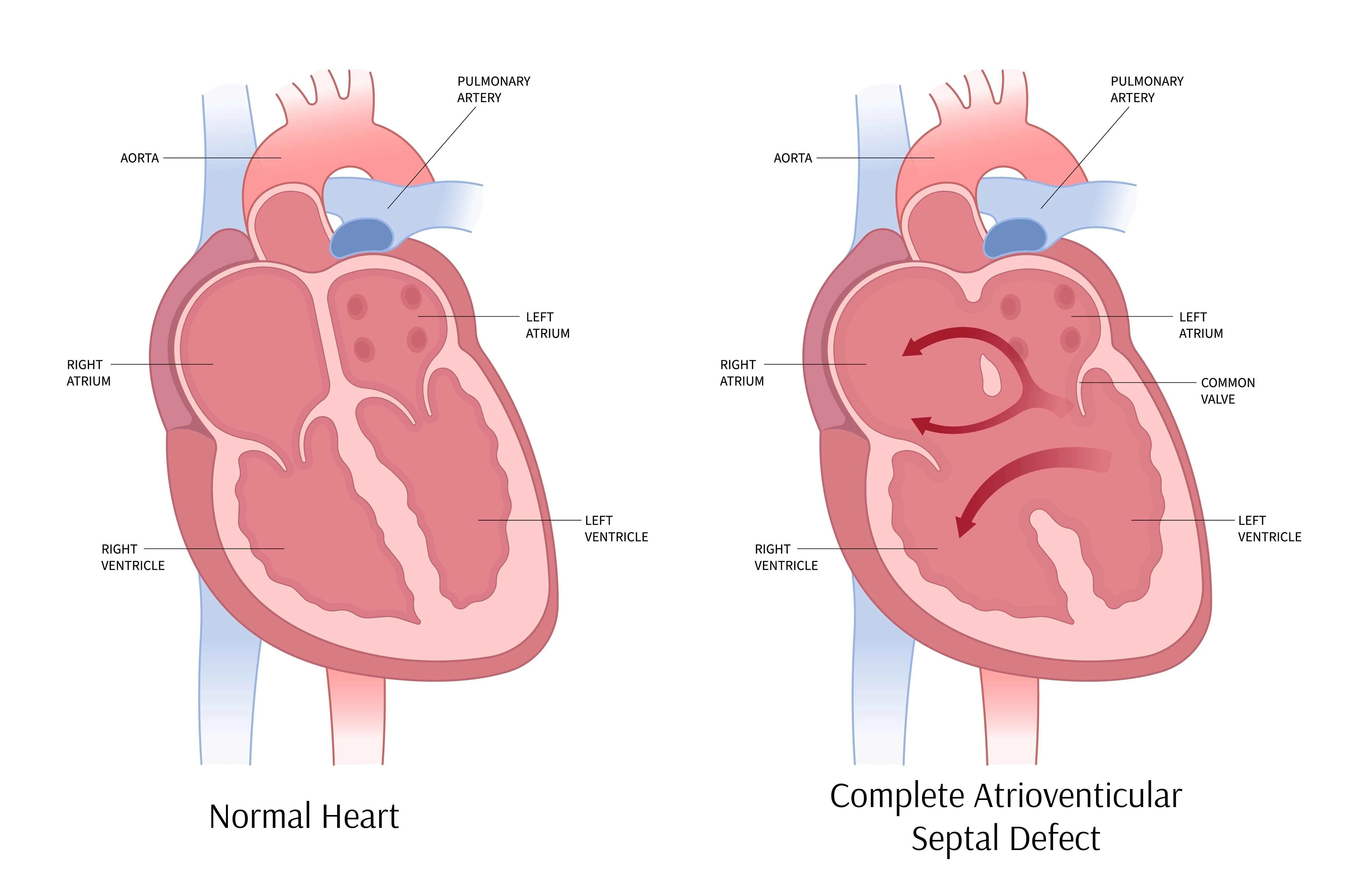 Complete Atrioventricular Septal Defect | https://www.harleystreet.sg/