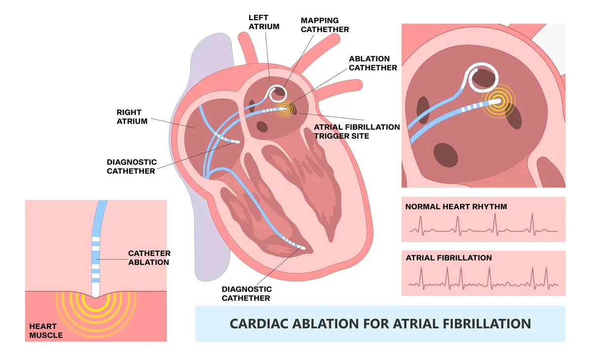 Electrophysiological Studies | https://www.harleystreet.sg/