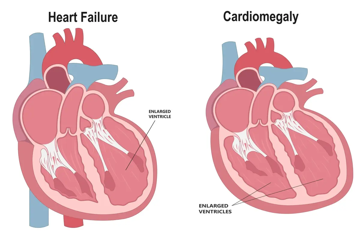 Enlarged Heart and Heart Failure | https://www.harleystreet.sg/