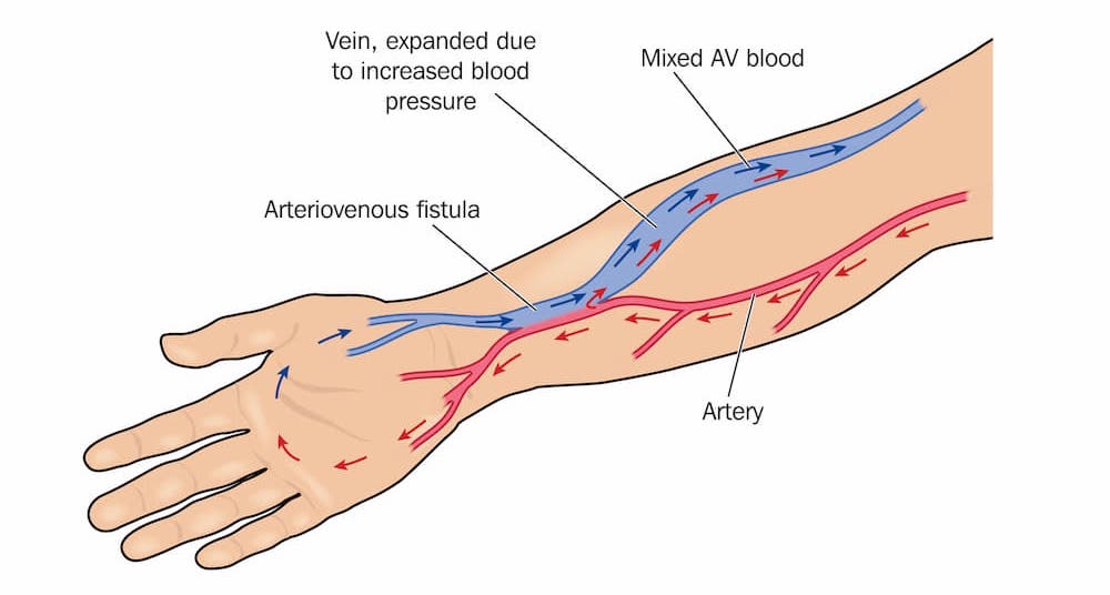 Vascular Access Surgery