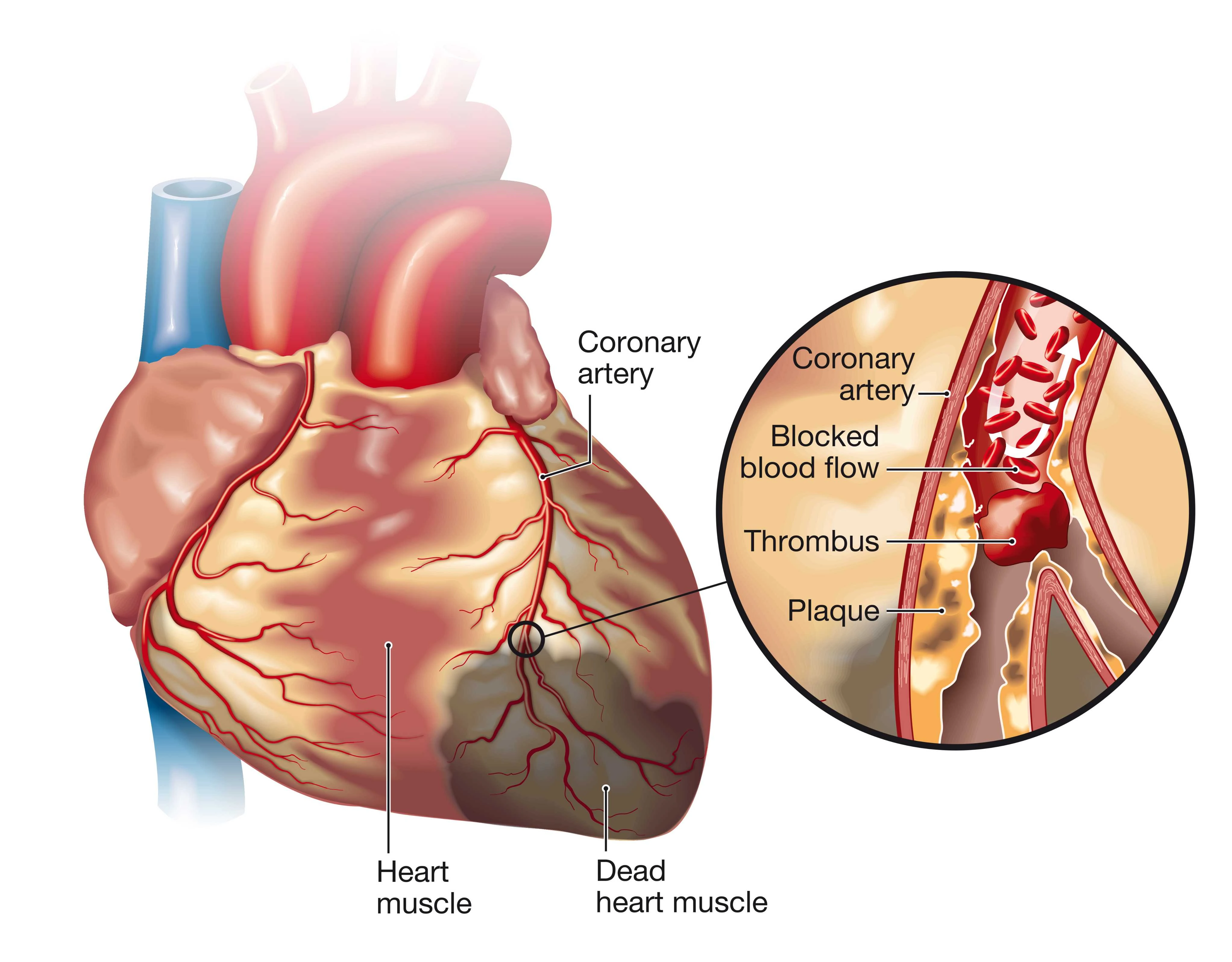 Heart Attack in Men | https://www.harleystreet.sg/