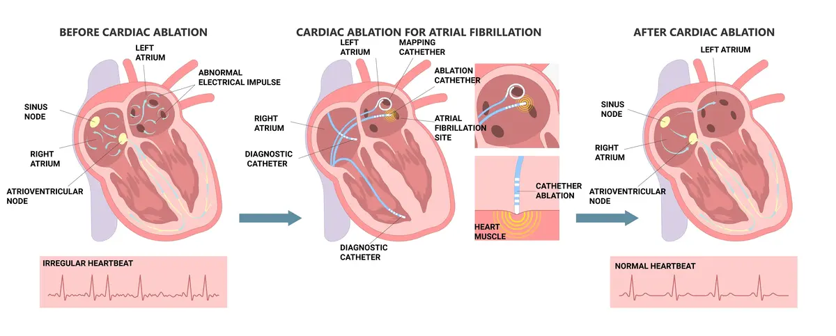 How DoescCatheter Ablation Work | https://www.harleystreet.sg/