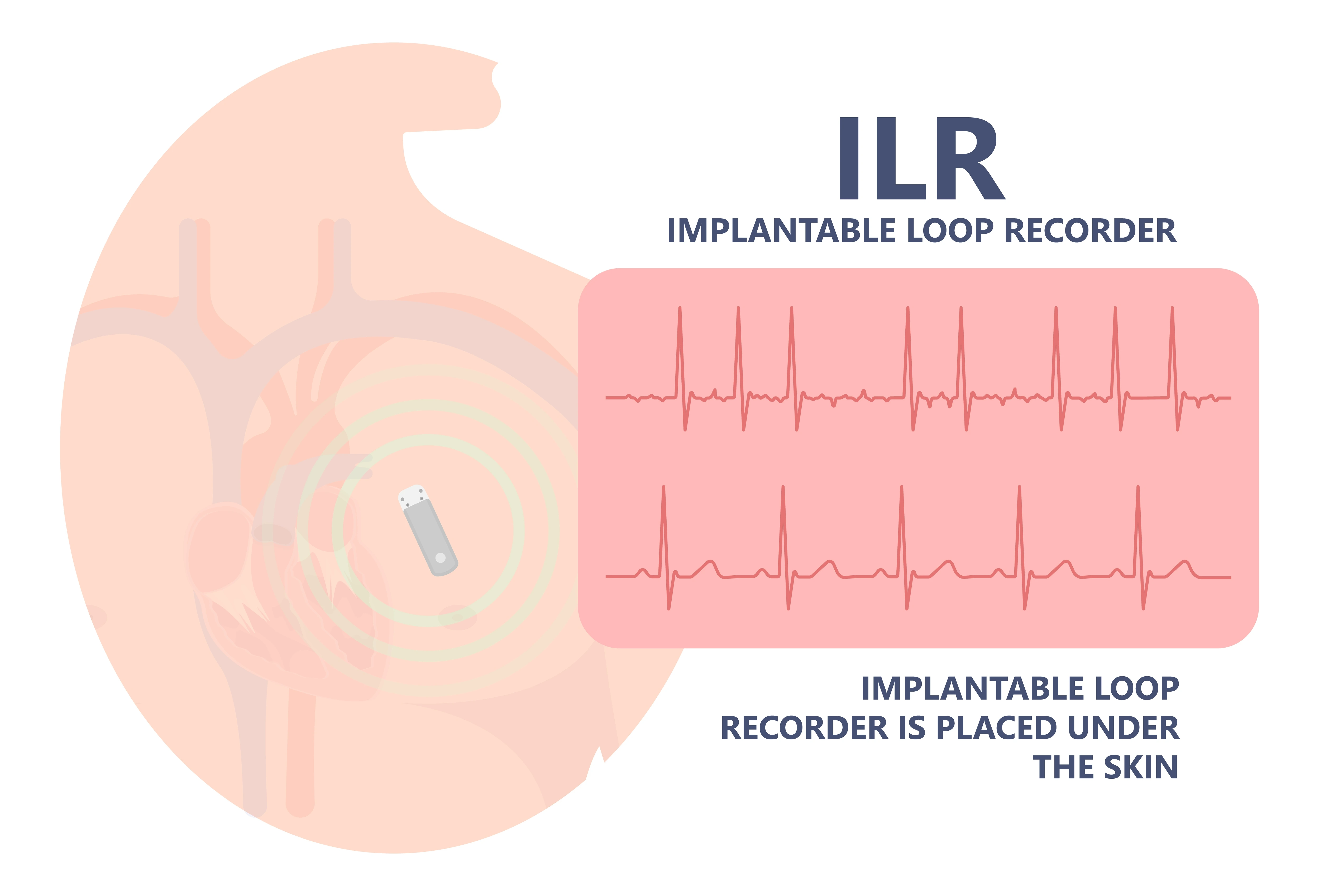 Implantable Loop Recorders | https://www.harleystreet.sg/