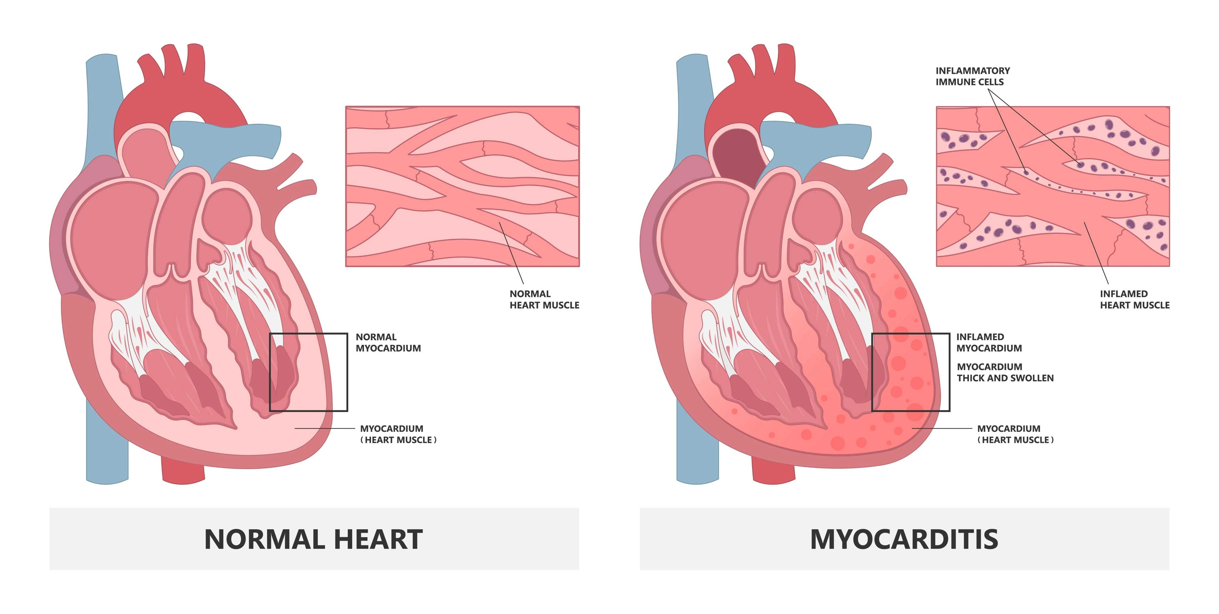 Myocarditis | https://www.harleystreet.sg/