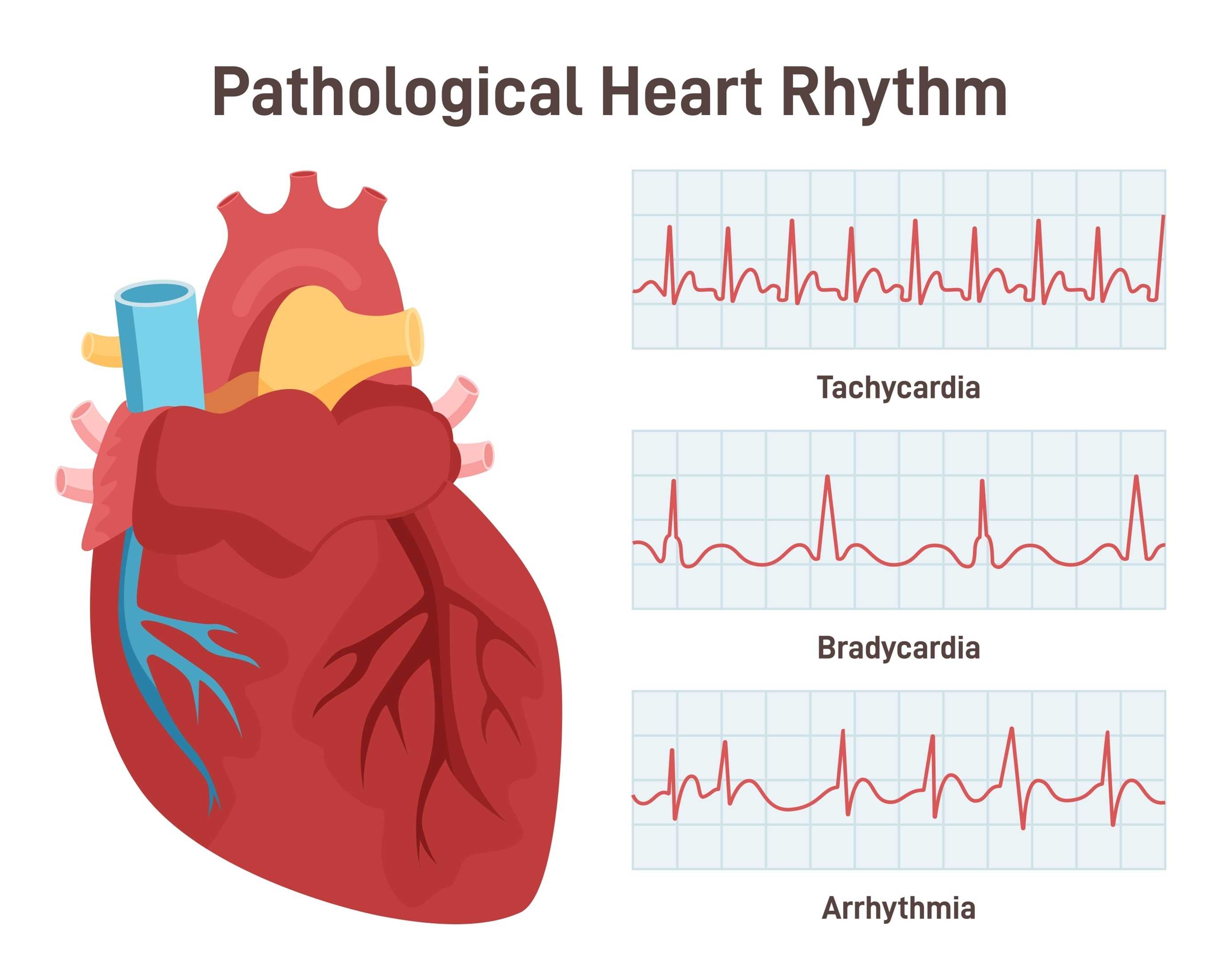 Heart Rhythm Pathology | https://www.harleystreet.sg/