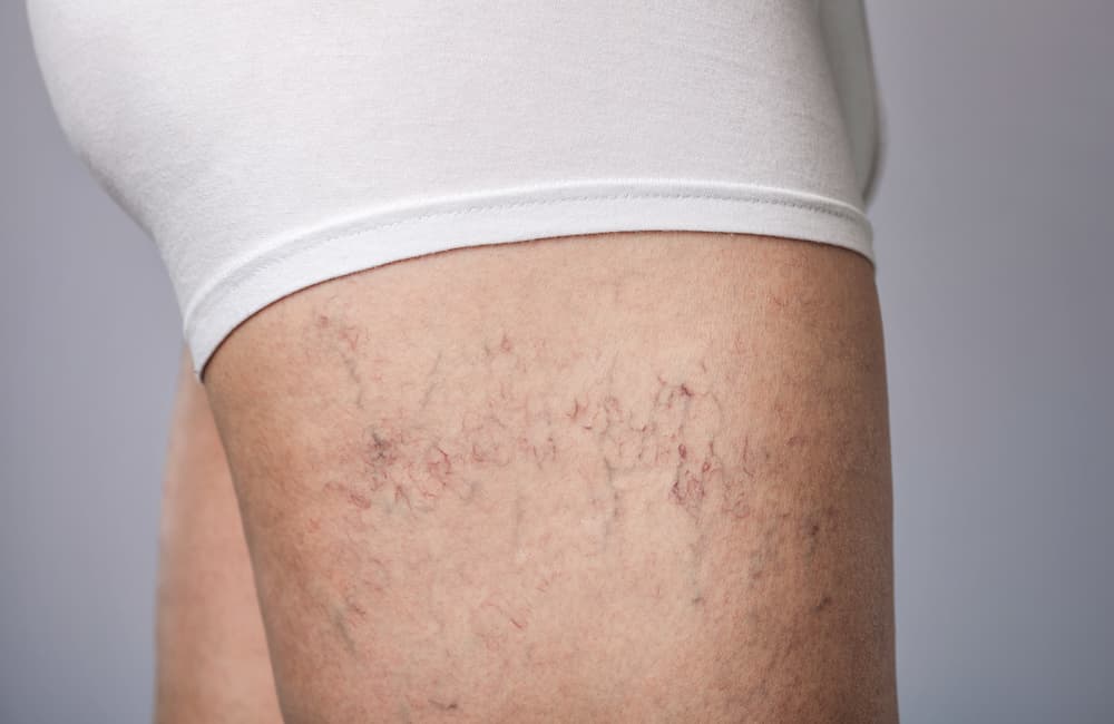 Spider Veins