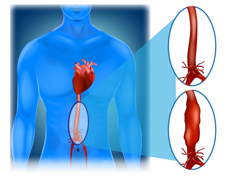 Aortic Surgery and Stenting