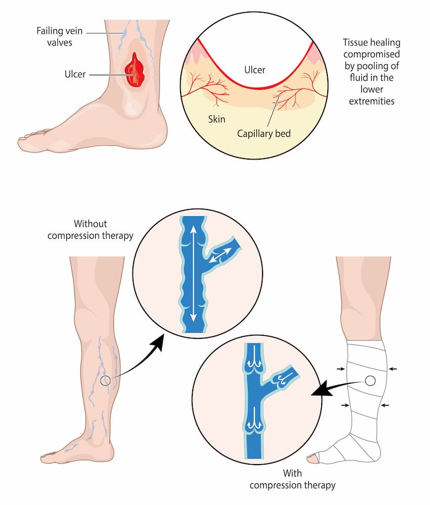 Leg Compression Therapy