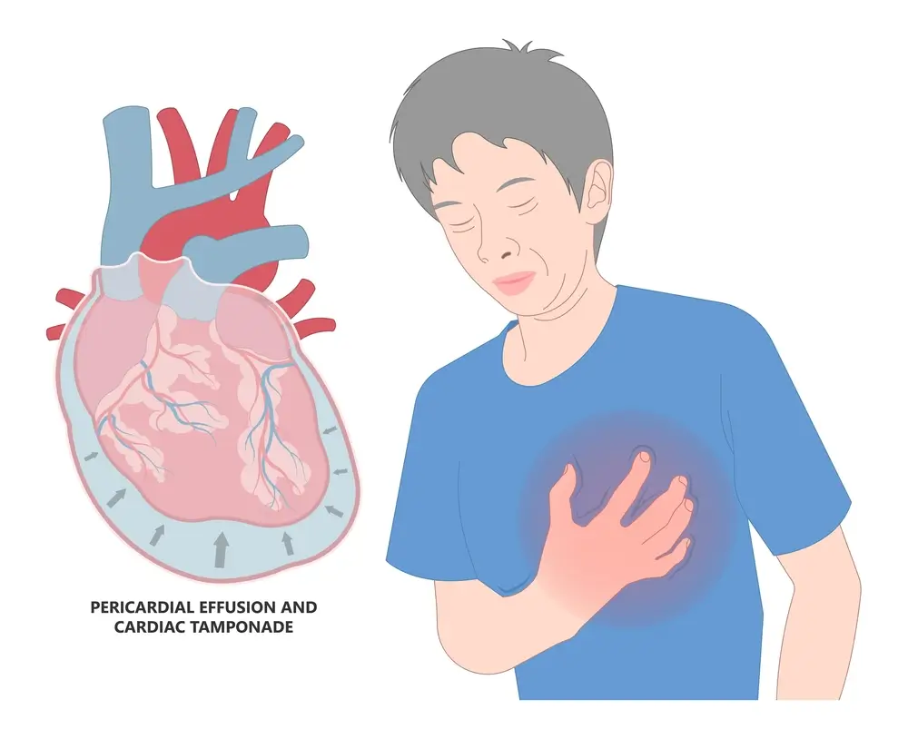 Treatment of Cardiac tamponade | https://www.harleystreet.sg/