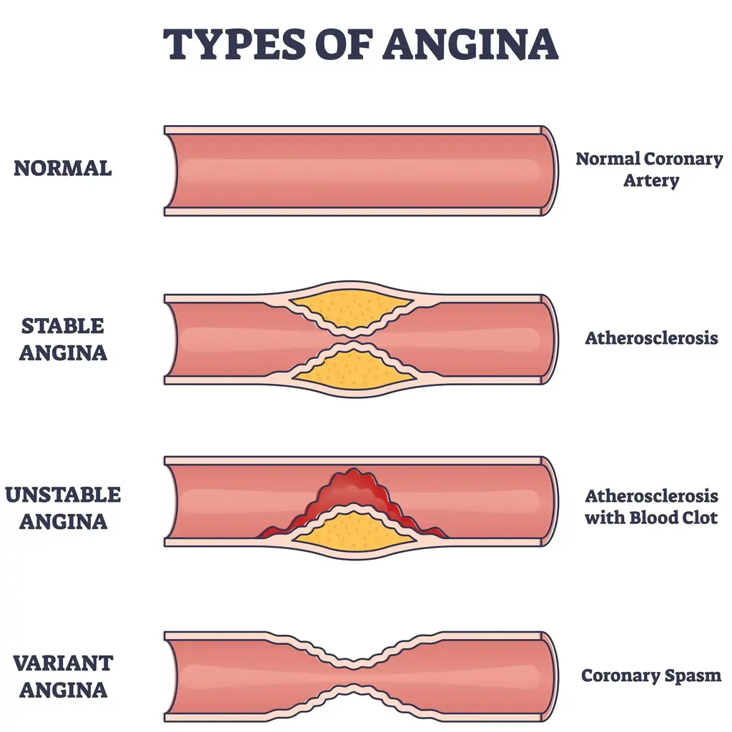 Types of Angina | https://www.harleystreet.sg/