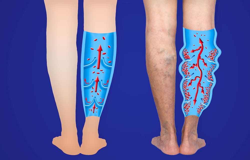 Varicose Veins