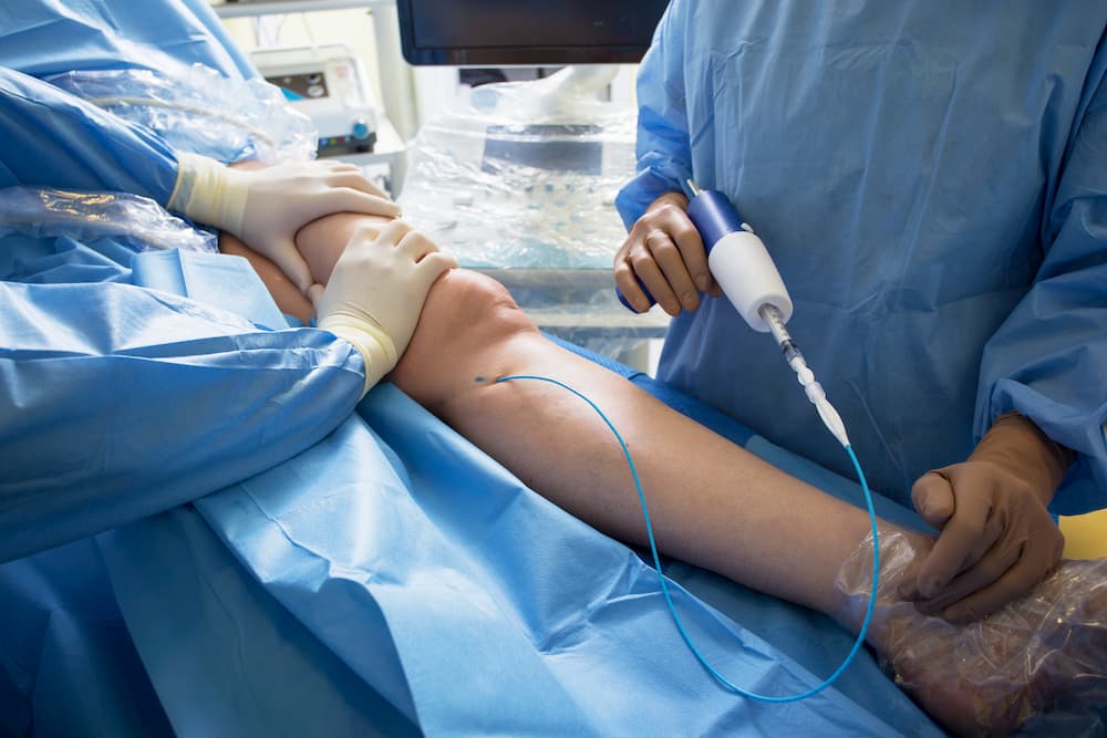 Venous glue ablation for varicose veins