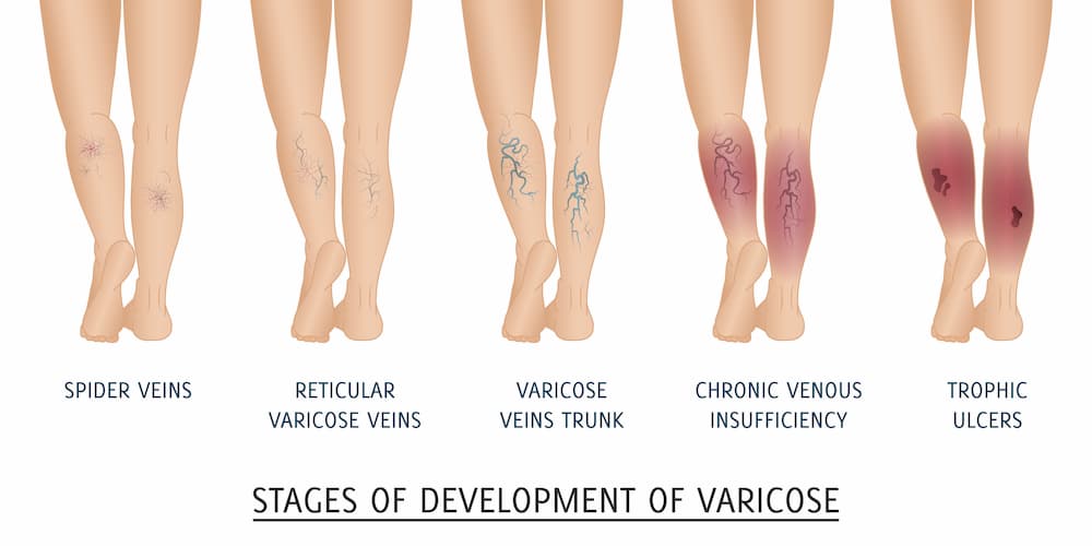 Stages Of Development Of Vein Disease