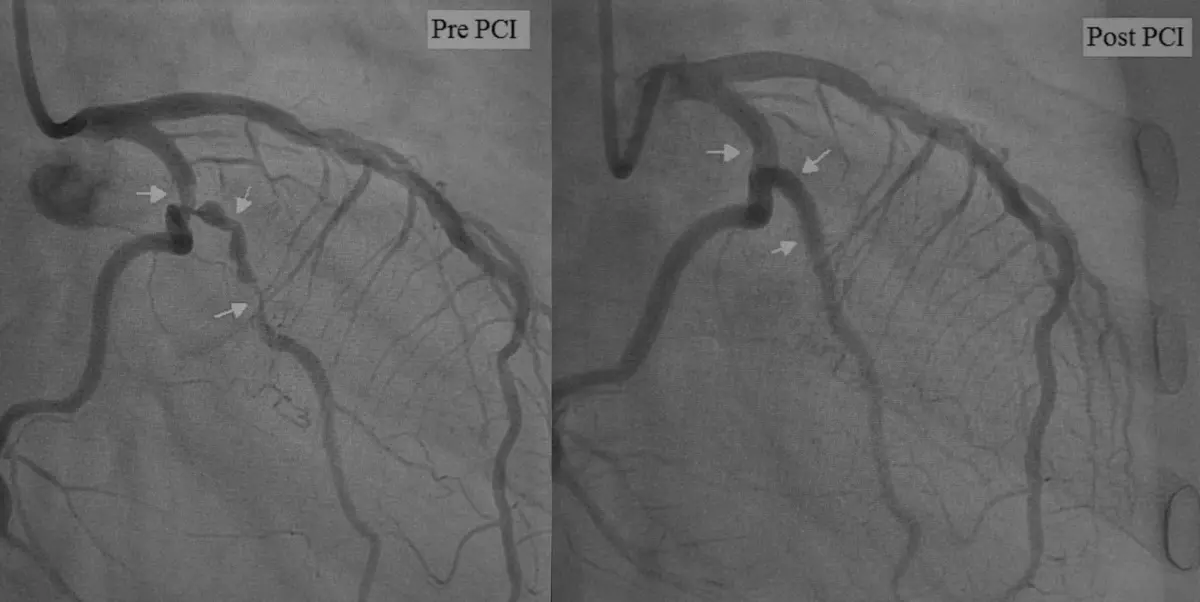 What is a Coronary Angiogram | https://www.harleystreet.sg/