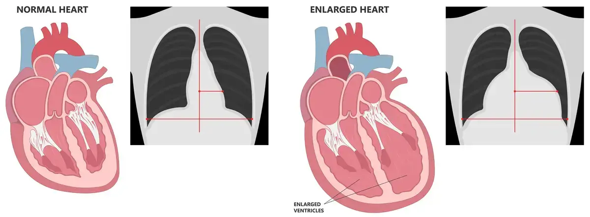 What is Cardiomegaly | https://www.harleystreet.sg/
